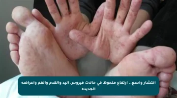 انتشار واسع.. ارتفاع ملحوظ في حالات فيروس اليد والقدم والفم وأعراضه الجديدة